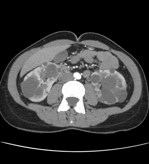 Autosomal dominant polycystic kidney disease - early onset (Radiopaedia 40734-43387 B 37).jpg