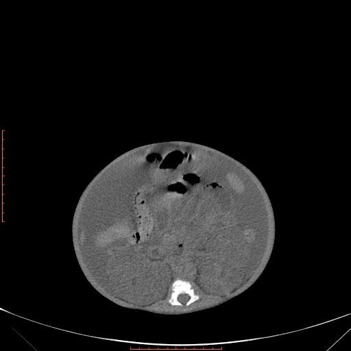 Autosomal recessive polycystic kidney disease associated with Caroli disease (Radiopaedia 61932-69984 Axial non-contrast 216).jpg