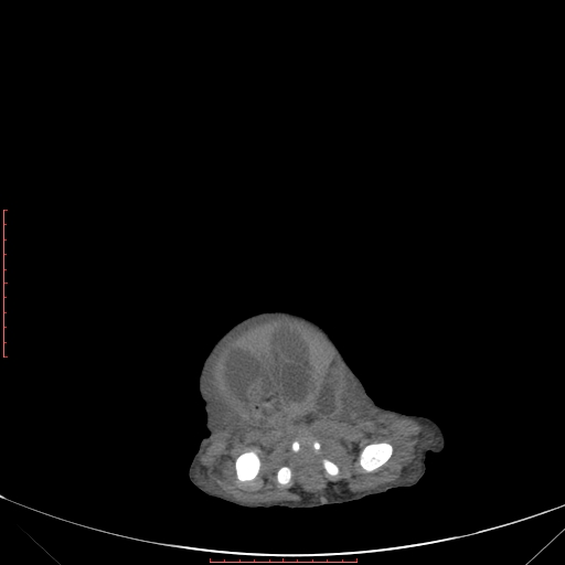 Autosomal recessive polycystic kidney disease associated with Caroli disease (Radiopaedia 61932-69984 Axial non-contrast 353).jpg
