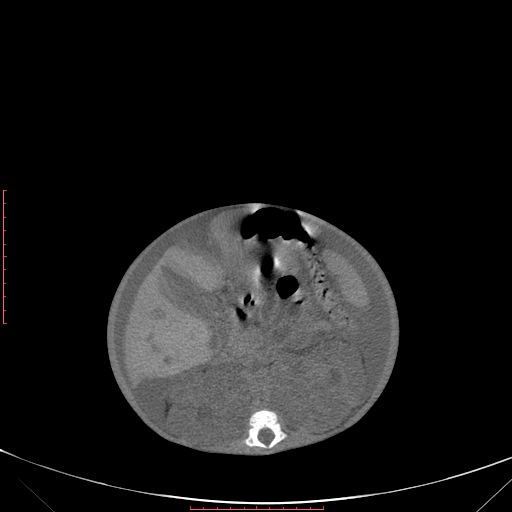 Autosomal recessive polycystic kidney disease associated with Caroli disease (Radiopaedia 61932-69984 B 194).jpg