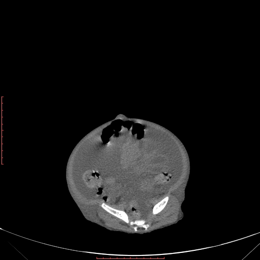 Autosomal recessive polycystic kidney disease associated with Caroli disease (Radiopaedia 61932-69984 B 300).jpg
