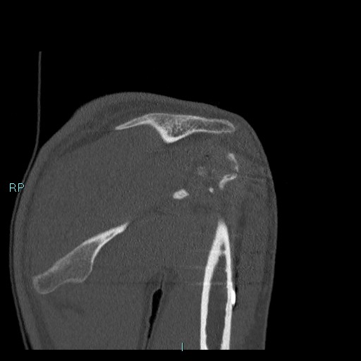 Avascular necrosis after fracture dislocations of the proximal humerus (Radiopaedia 88078-104655 Coronal bone window 58).jpg