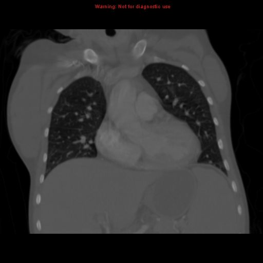 Avascular necrosis in sickle cell disease (Radiopaedia 17448-17152 Coronal bone window 48).jpg