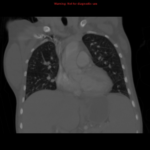 File:Avascular necrosis in sickle cell disease (Radiopaedia 17448-17152 Coronal bone window 53).jpg