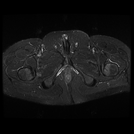 File:Avascular necrosis of the hip (Radiopaedia 61503-69465 Axial STIR 25).jpg