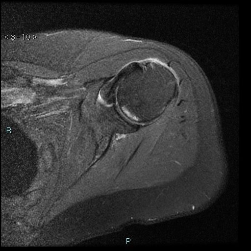 File:Avascular necrosis of the shoulder - Cruess stage I (Radiopaedia 77674-89886 Axial PD fat sat 10).jpg