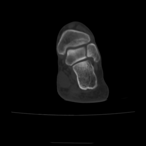 Avulsion fracture of the dorsal cuboid bone (Radiopaedia 51586-57377 Axial bone window 13).jpg