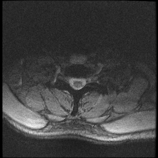 File:Axis fracture - MRI (Radiopaedia 71925-82375 Axial T2 fat sat 19).jpg