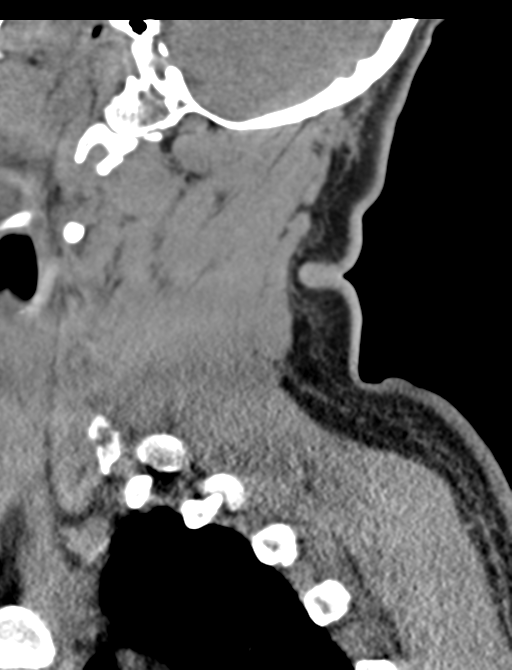 Axis peg fracture (type 3) and atlas lateral mass (type 4) fracture (Radiopaedia 37474-39324 D 18).png