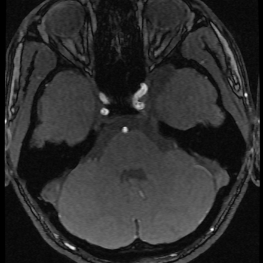 Azygos anterior cerebral artery (Radiopaedia 17059-16756 Axial MRA 63).jpg