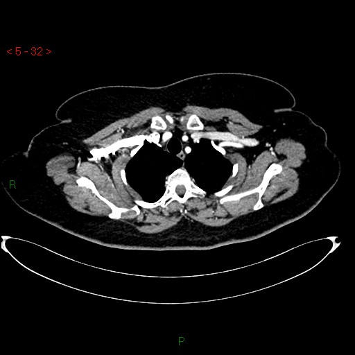 Azygos fissure and lobe (Radiopaedia 47620-52278 A 18).jpg