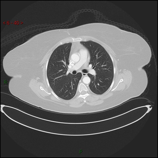 Azygos fissure and lobe (Radiopaedia 47620-52278 Axial lung window 40).jpg