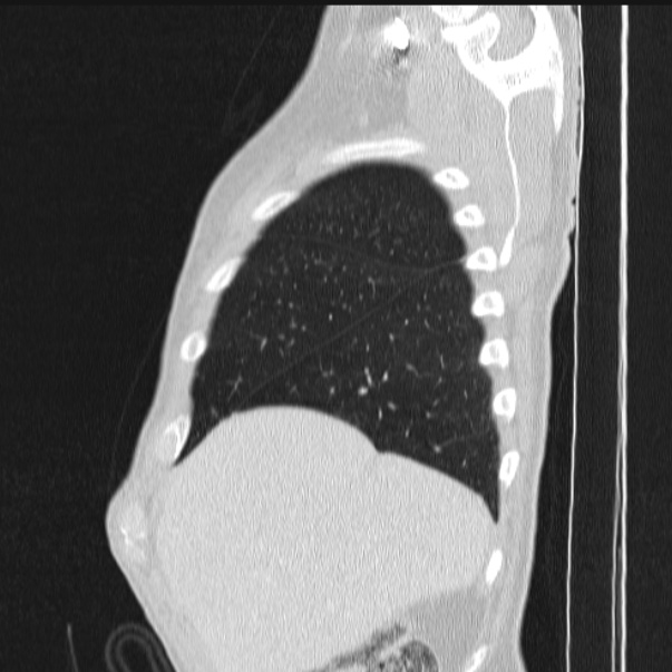 Azygos lobe (Radiopaedia 38259-40275 lung window 17).jpg