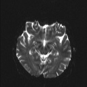 Balo concentric sclerosis (Radiopaedia 50458-55940 Axial DWI 13).jpg
