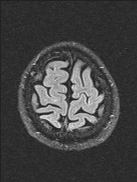 File:Balo concentric sclerosis (Radiopaedia 50458-55940 Axial FLAIR 5).jpg