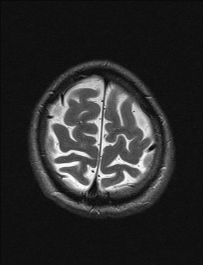 File:Balo concentric sclerosis (Radiopaedia 50458-55940 Axial T2 5).jpg