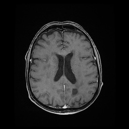 Balo concentric sclerosis (Radiopaedia 53875-59982 Axial LAVA C+ 162).jpg