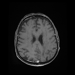 File:Balo concentric sclerosis (Radiopaedia 53875-59982 Axial LAVA C+ 174).jpg