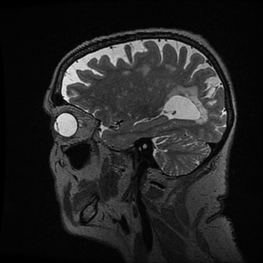 Balo concentric sclerosis (Radiopaedia 53875-59982 Sagittal 3D FSE 85).jpg