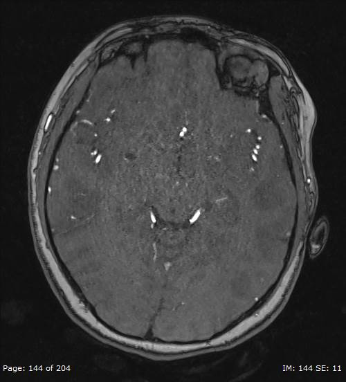 Balo concentric sclerosis (Radiopaedia 61637-69636 Axial MRA 144).jpg