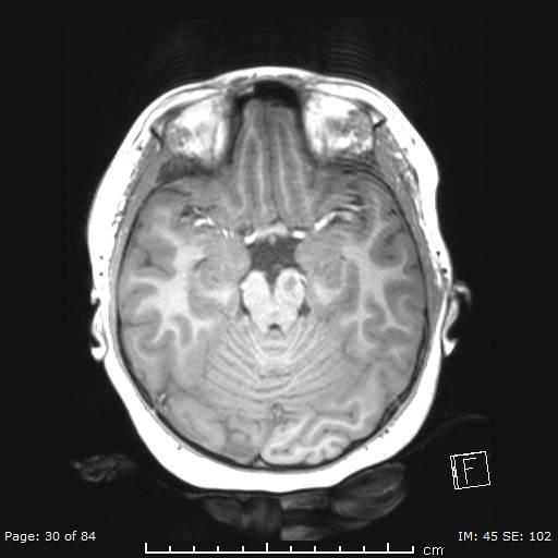 Balo concentric sclerosis (Radiopaedia 61637-69636 Axial T1 30).jpg