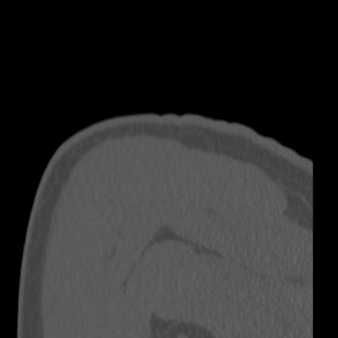 Bankart lesion (Radiopaedia 57256-64185 Coronal bone window 47).jpg