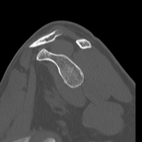 Bankart lesion (Radiopaedia 57256-64185 Sagittal bone window 31).jpg