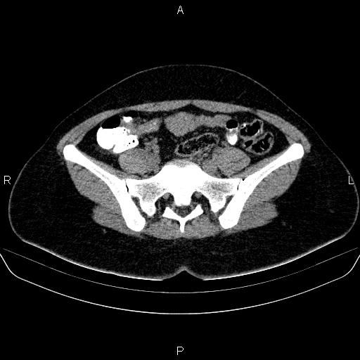 Bartholin gland cyst (Radiopaedia 62635-70930 Axial non-contrast 20).jpg