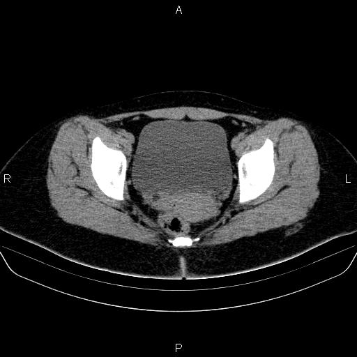 Bartholin gland cyst (Radiopaedia 62635-70930 Axial non-contrast 58).jpg
