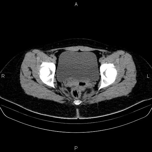 Bartholin gland cyst (Radiopaedia 62635-70930 Axial non-contrast 62).jpg