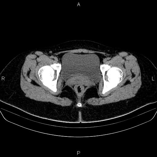 Bartholin gland cyst (Radiopaedia 62635-70930 Axial non-contrast 68).jpg
