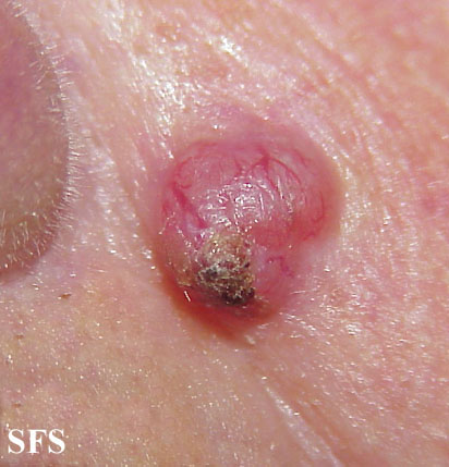 Basal Cell Carcinoma (Dermatology Atlas 96).jpg