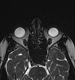 Basal cell carcinoma - nasal region (Radiopaedia 70292-80365 Axial Gradient Echo 65).jpg