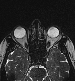 Basal cell carcinoma - nasal region (Radiopaedia 70292-80365 Axial Gradient Echo 70).jpg
