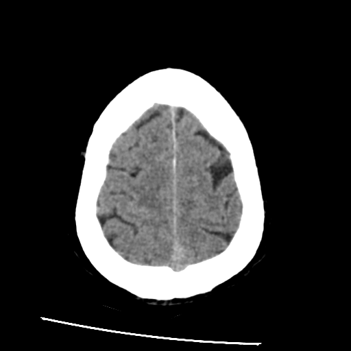 File:Basilar artery occlusion (Radiopaedia 33570-34659 Axial non-contrast 31).png