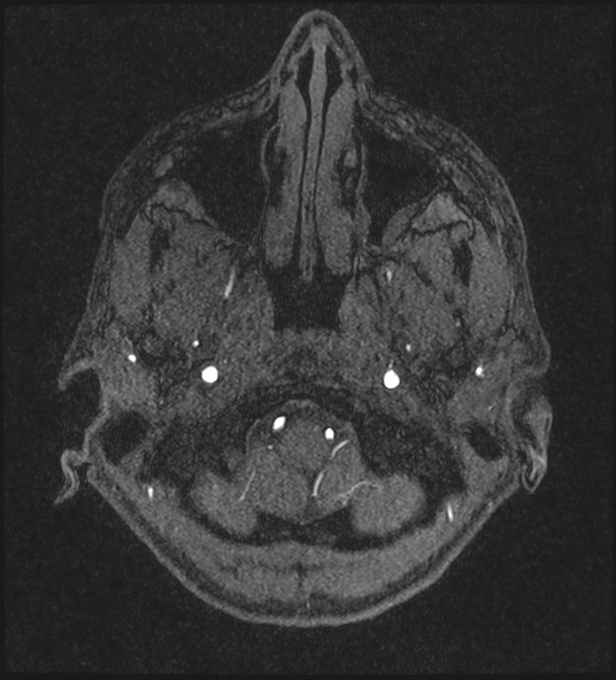 Basilar artery perforator aneurysm (Radiopaedia 82455-97733 Axial MRA 25).jpg