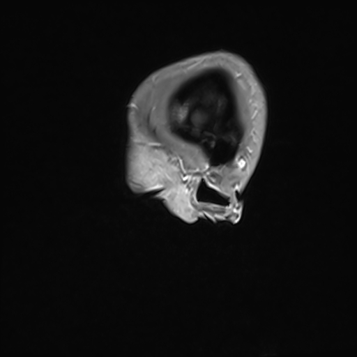 Basilar artery perforator aneurysm (Radiopaedia 82455-97733 G 11).jpg