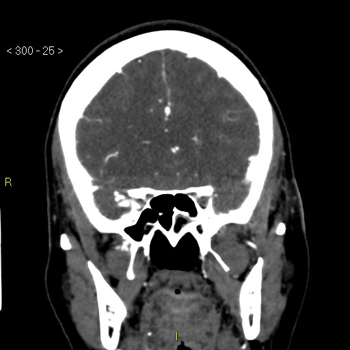 Basilar artery thrombosis (Radiopaedia 16260-15944 B 16).jpg