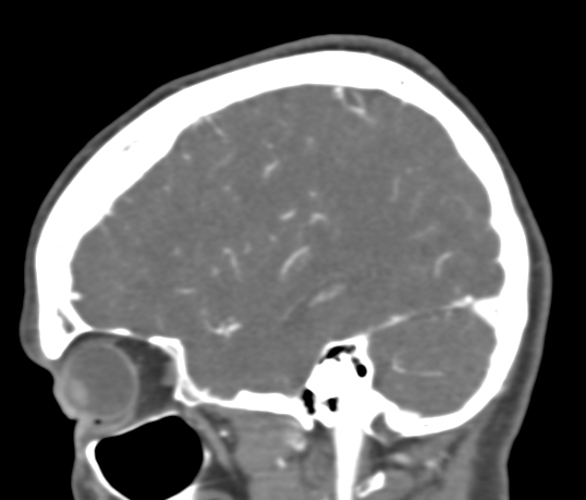 Basilar tip aneurysm with coiling (Radiopaedia 53912-60086 C 30).jpg