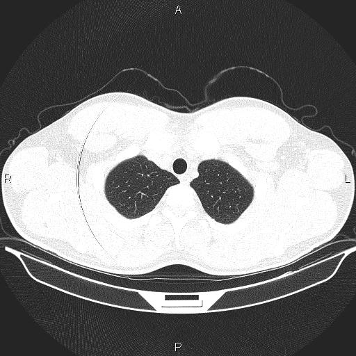 Beam hardening and ring artifacts (Radiopaedia 85323-100915 Axial lung window 13).jpg