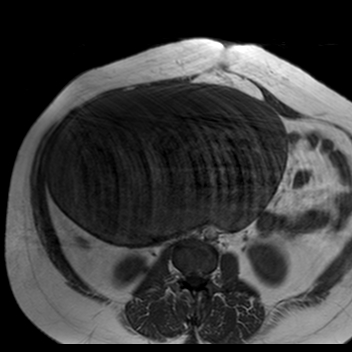 File:Benign seromucinous cystadenoma of the ovary (Radiopaedia 71065-81300 Axial T1 25).jpg
