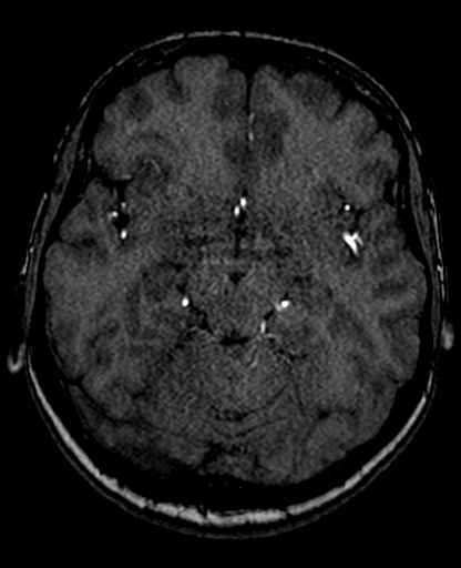 File:Berry aneurysm of the terminal internal carotid artery (Radiopaedia 88286-104918 Axial TOF 107).jpg