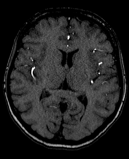 Berry aneurysm of the terminal internal carotid artery (Radiopaedia 88286-104918 Axial TOF 134).jpg