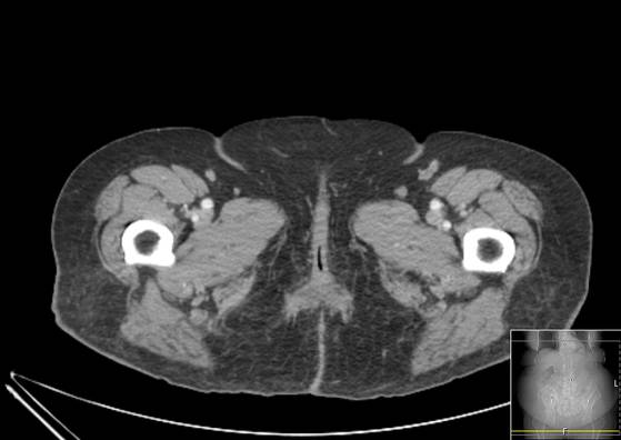 Bicameral celiacomesenteric aneurysm (Radiopaedia 55766-62327 A 83).jpg