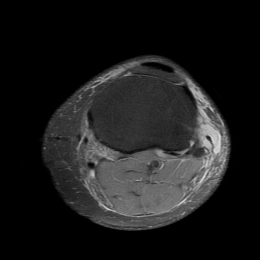 File:Biceps femoris distal tendon avulsion (Radiopaedia 15109-14987 Axial PD fat sat 20).jpg