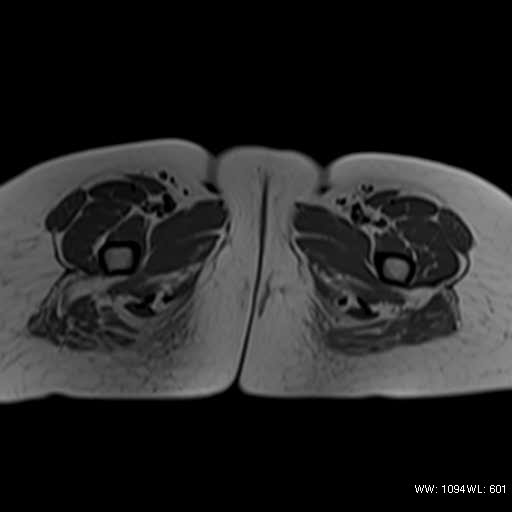 File:Bicornuate uterus- on MRI (Radiopaedia 49206-54297 Axial T1 20).jpg