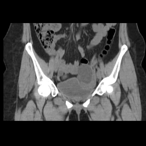 File:Bicornuate uterus (MRI) (Radiopaedia 49206-54296 Coronal 9).jpg