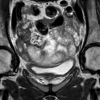 File:Bicornuate uterus (Radiopaedia 61974-70046 Coronal T2 5).jpg