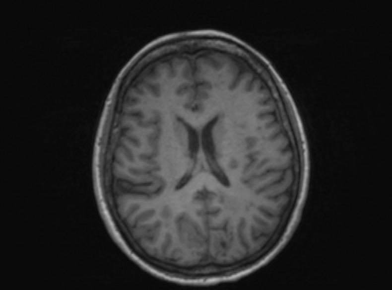 Bilateral PCA territory infarction - different ages (Radiopaedia 46200-51784 Axial T1 211).jpg