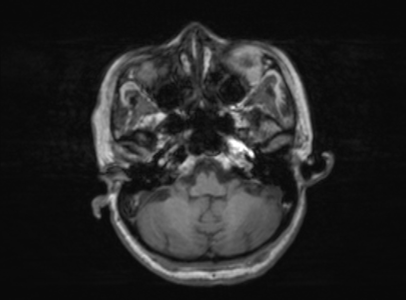 Bilateral PCA territory infarction - different ages (Radiopaedia 46200-51784 Axial T1 315).jpg